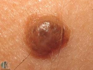 Mole Removal Home Kits: Are They Safe to Use?